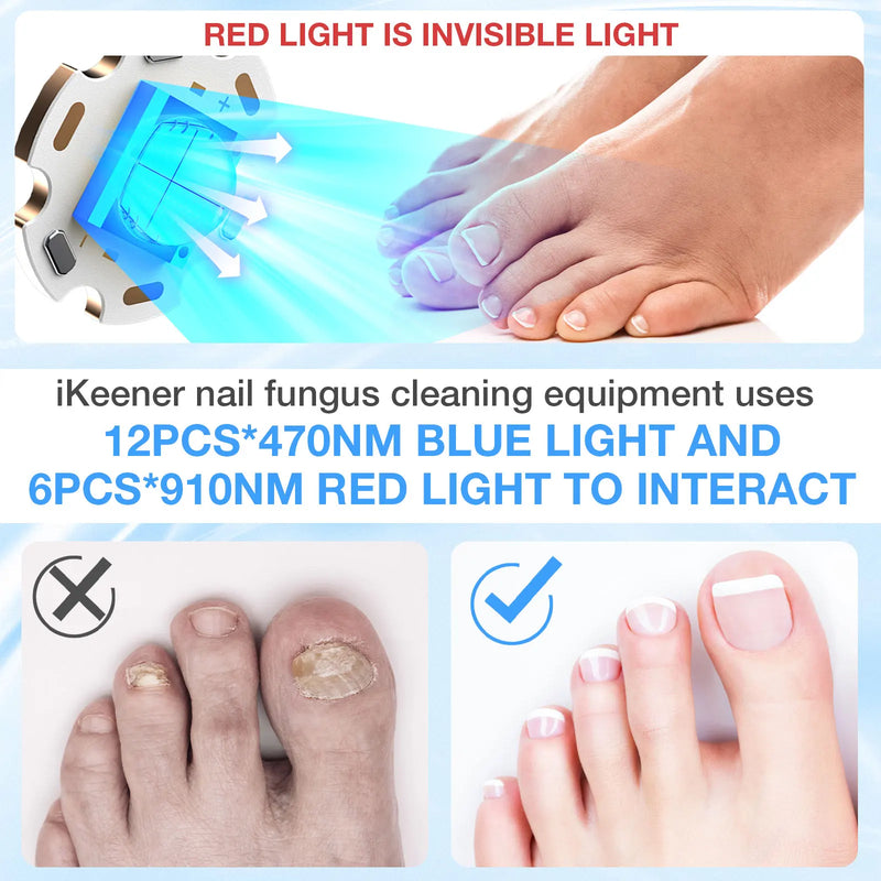 KTS Fungal Nail Laser Device Repair Fast Nails Fungus Onychomycosis Repair Toenail Fingernail Removes Nail Fungus Foot Care