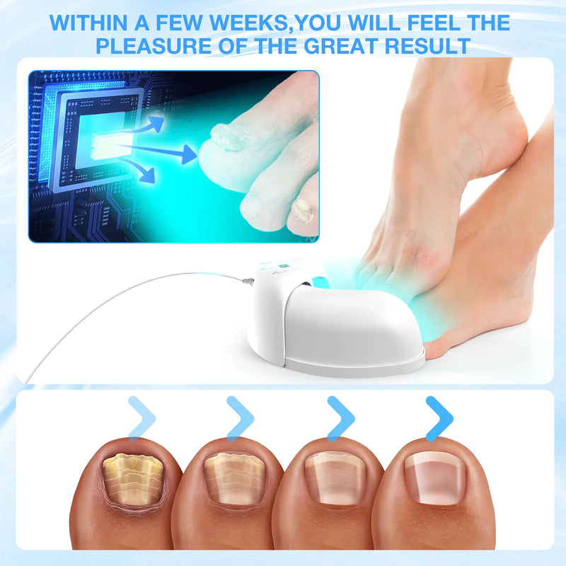 KTS Fungal Nail Laser Device Repair Fast Nails Fungus Onychomycosis Repair Toenail Fingernail Removes Nail Fungus Foot Care